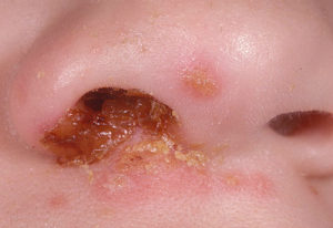 Чем лечить болячки в носу у ребенка?
